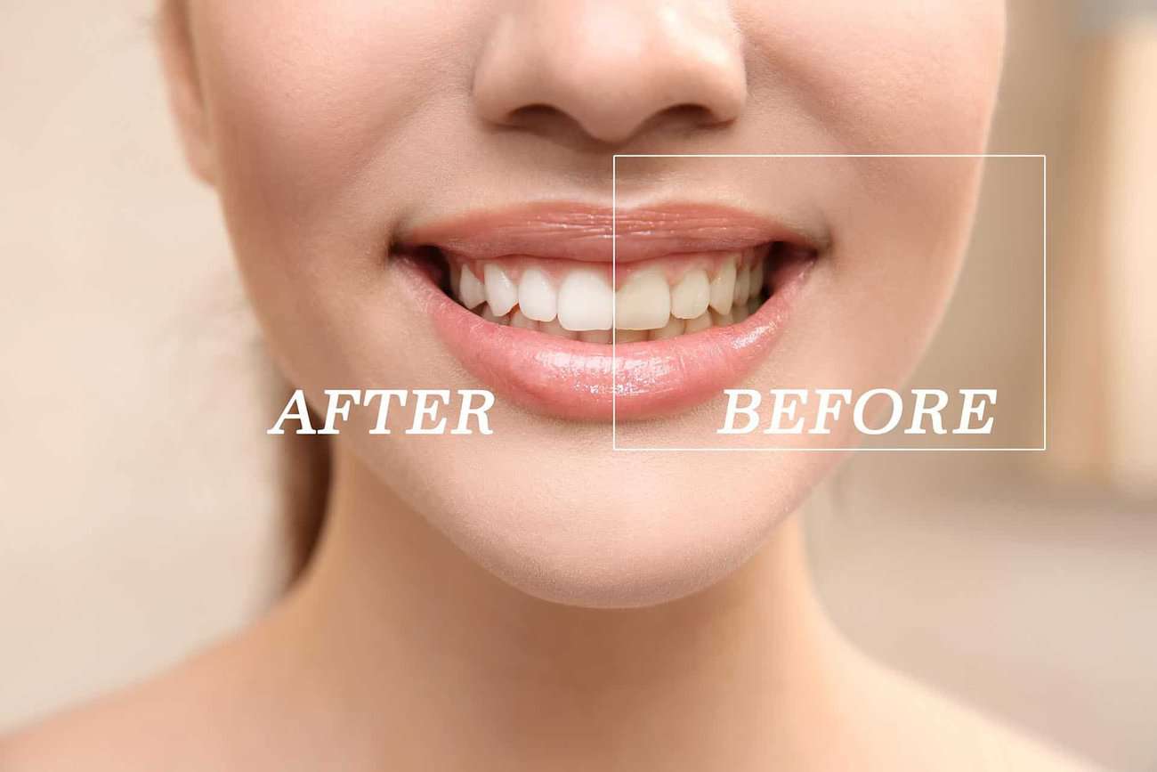 How Can You Maintain a Consistent Smile Shade with Crowns Fylde?