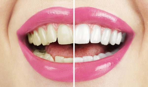 What Makes Ultima White Teeth Whitening Different Fylde