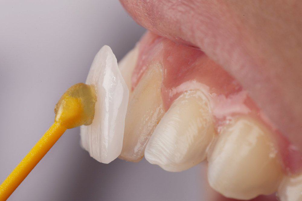Why Do Dental Crowns Fail or Get Damaged Prematurely Fylde?