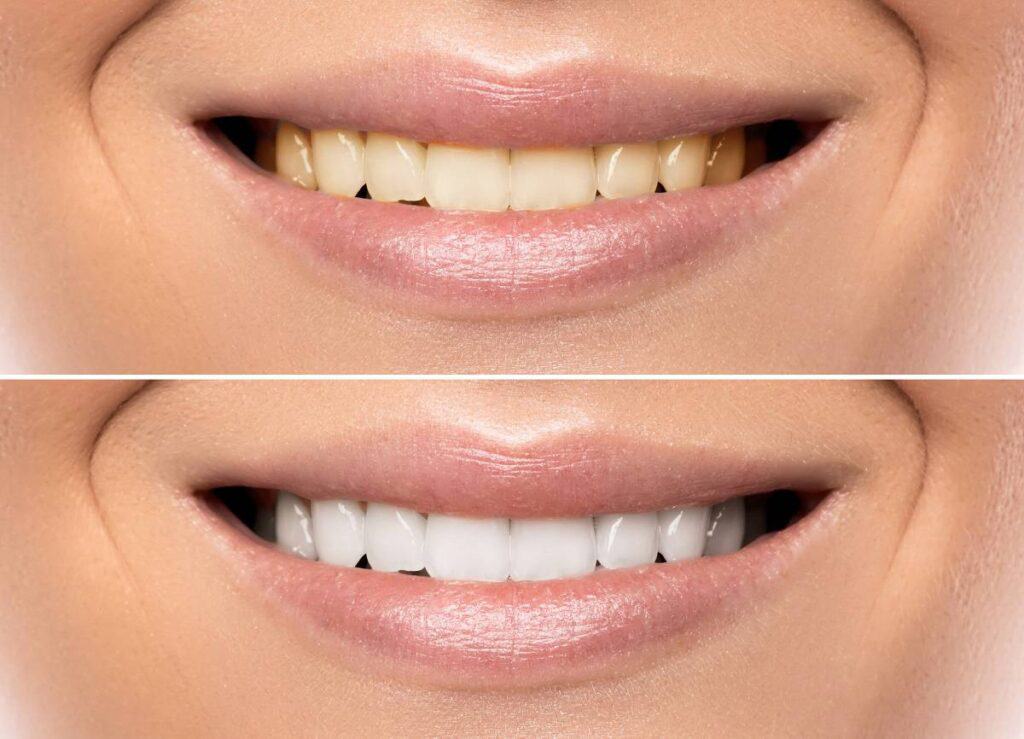 How Can You Protect Your White Smile as a Coffee Lover Fylde?