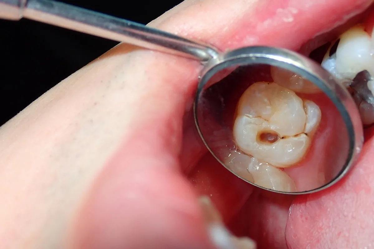 Why Do Teeth Crack? Common Causes to Know Fylde