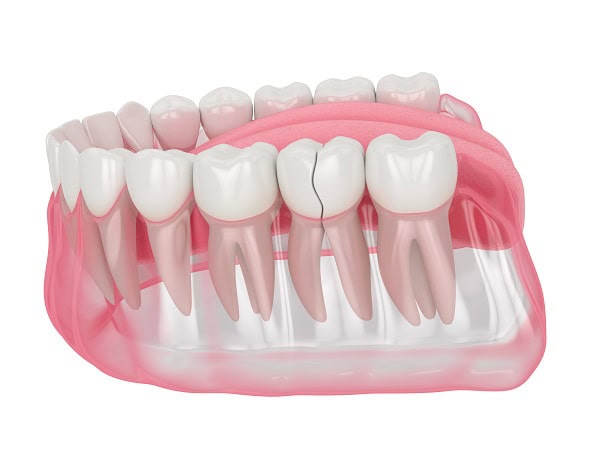 How Can You Manage Pain and Discomfort After a Root Canal Fylde?