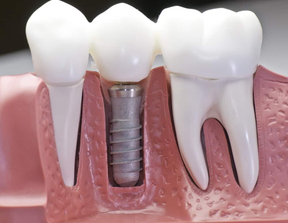Who Is a Good Candidate for Dental Implants Fylde?