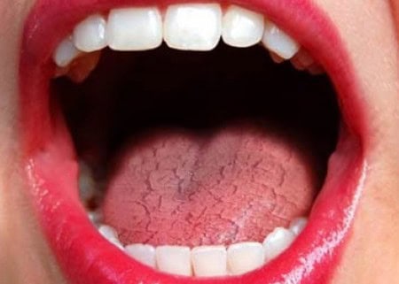 Dry Mouth and Its Role in Tooth Decay Fylde
