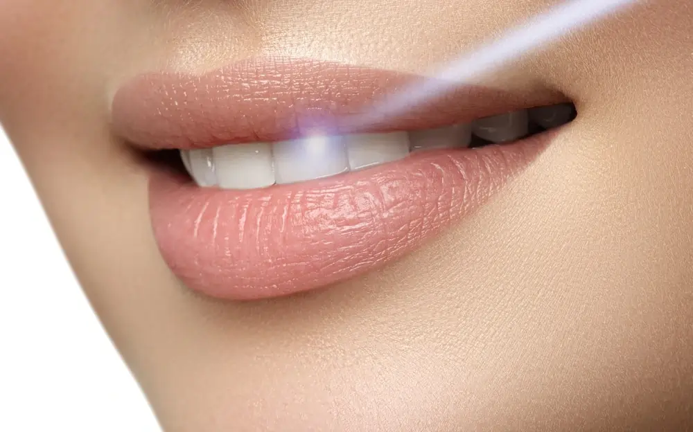 How Long Does Laser Teeth Whitening Last on Your Teeth Fylde?