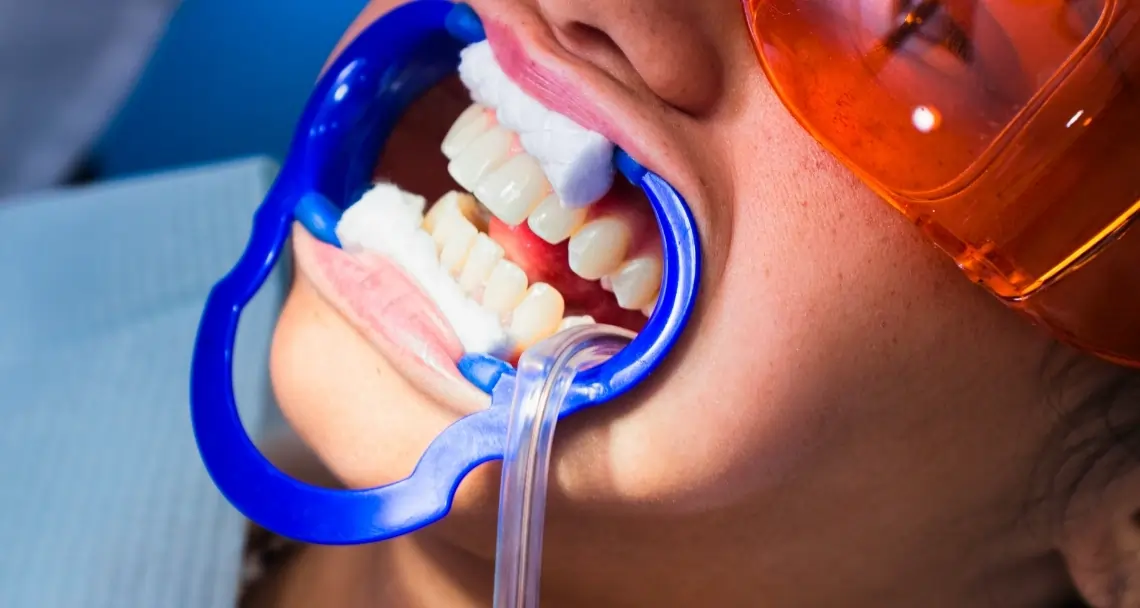 How Teeth Whitening Treatments Actually Work on Your Enamel Fylde