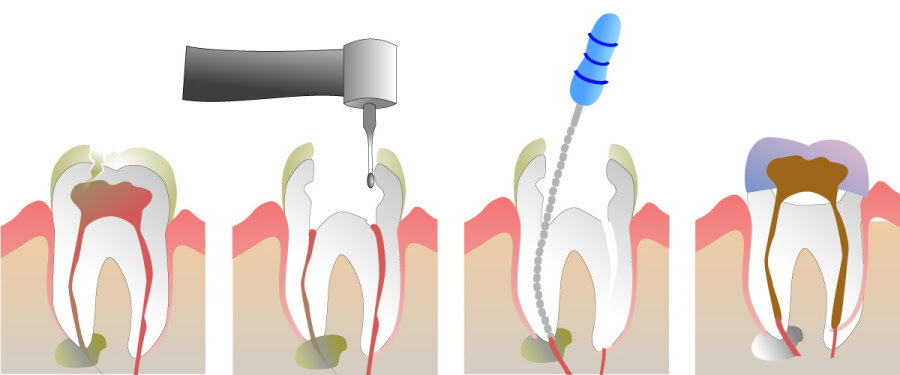 How Do You Properly Care for Your Teeth After a Root Canal Fylde