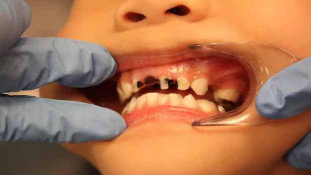 Can Your Diet Help You Achieve a Whiter, Healthier Smile Fylde?
