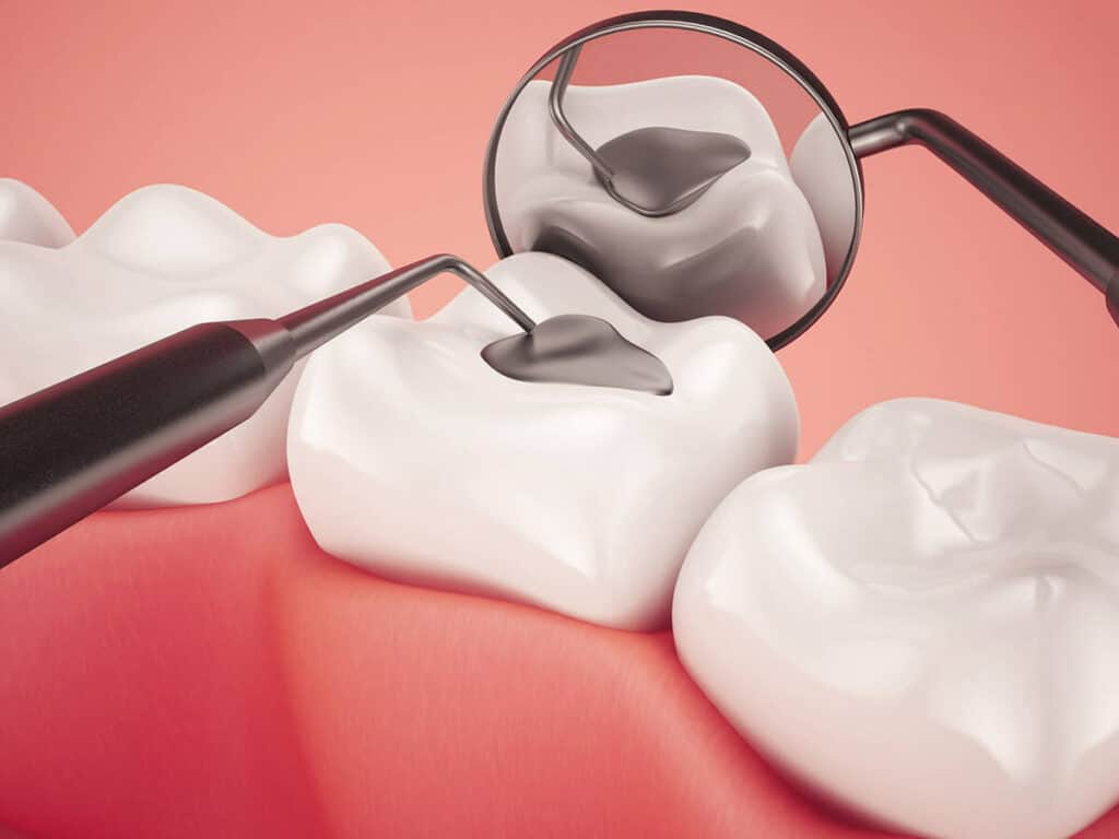 How Can You Prevent Tooth Decay Effectively Fylde