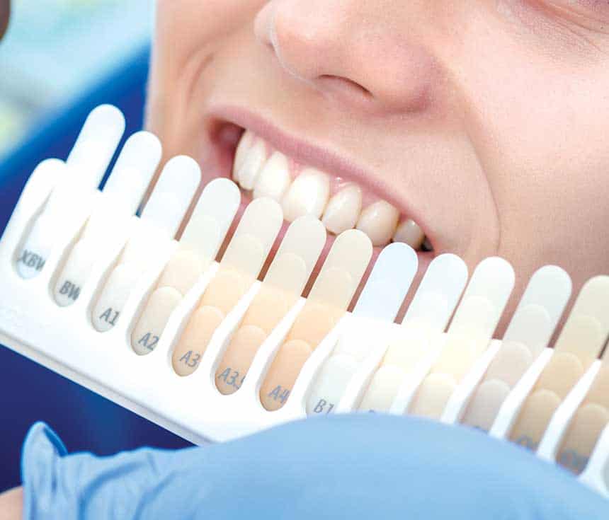 Is Laser Teeth Whitening Worth It for a Brighter, Confident Smile Fylde?