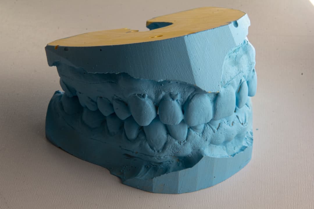 How Do Dental Implants Improve Jawbone Health and Oral Function Fylde?