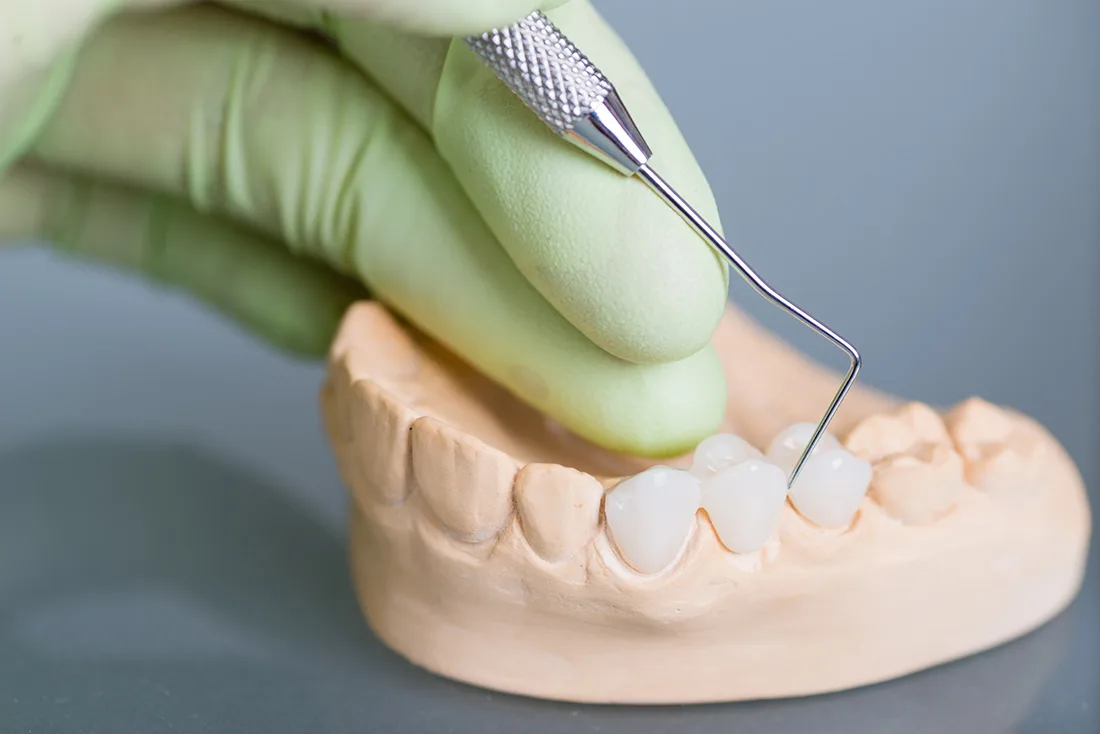 Do Braces Take Years to Show Results Fylde