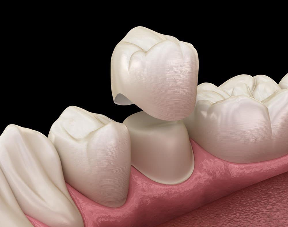 What is the Procedure for Getting Dental Implants Fylde?