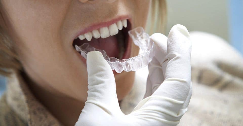 How Much Does Laser Teeth Whitening Cost Compared to Overnight Trays Fylde?